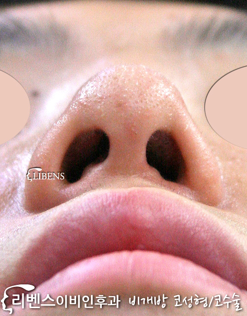 비대칭 콧구멍 교정 성형 수술 코끝 연골 재배치 묶기 성형 s118